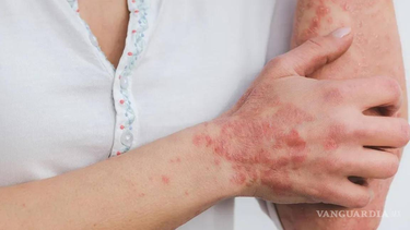 México: Salud emitió una alerta por casos de lepra en 12 municipios del país