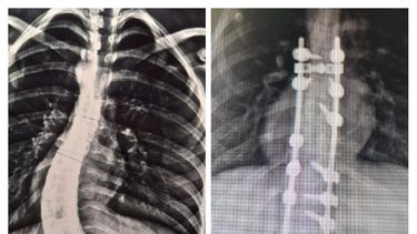 nueva intervencion de columna vertebral en la provincia
