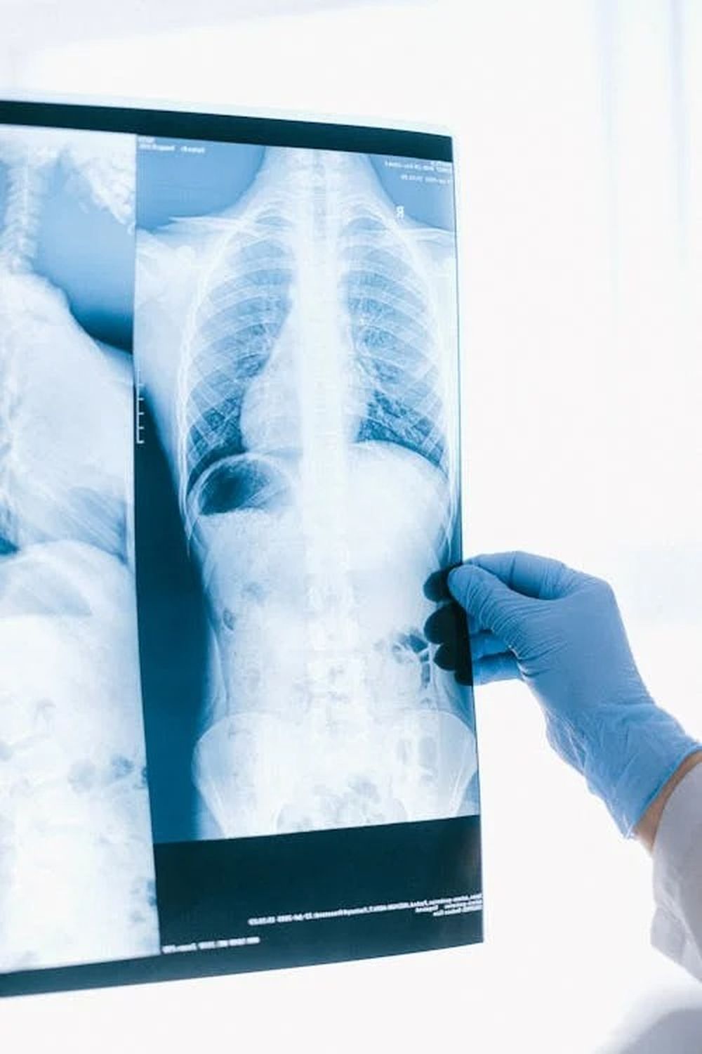 TUBERCULOSIS