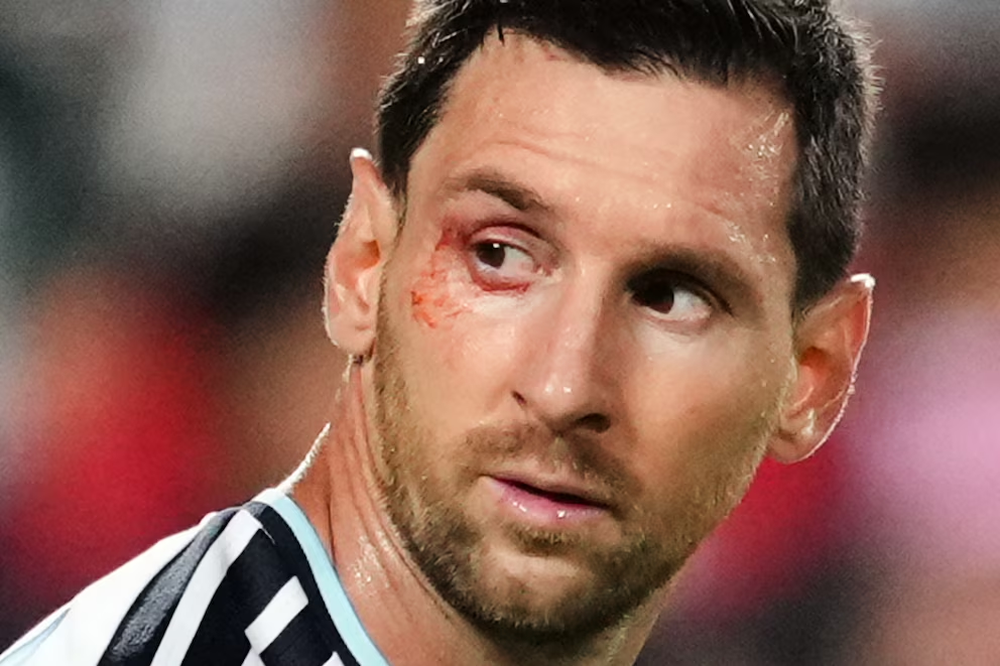 Qué le pasó a Lionel Messi en el ojo derecho durante el cruce ante Suiza