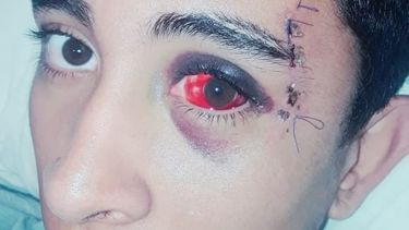 Temen que víctima de intento de robo pierda la vista de un ojo