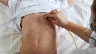 Salud emitió una alerta  por caso de sarampión y piden vacunar a los niños