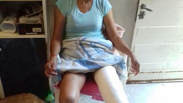 Mujer terminó con una doble fractura tras un arrebato violento