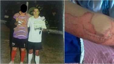 Boxeador roció con nafta y prendió fuego a su novia