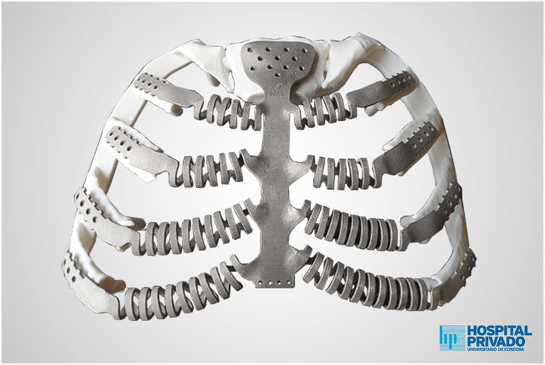 Reconstrucție toracică cu proteze 3D personalizate