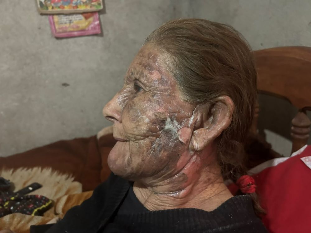 Salvaje. Rosalía (84) sufrió quemaduras en varias partes de su cuerpo.