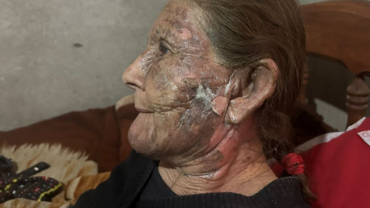 Quemó a su expareja y  lo imputaron por intento de homicidio agravado