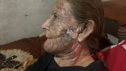 Salvaje. Rosalía (84) sufrió quemaduras en varias partes de su cuerpo. Salvaje. Rosalía (84) sufrió quemaduras en varias partes de su cuerpo.